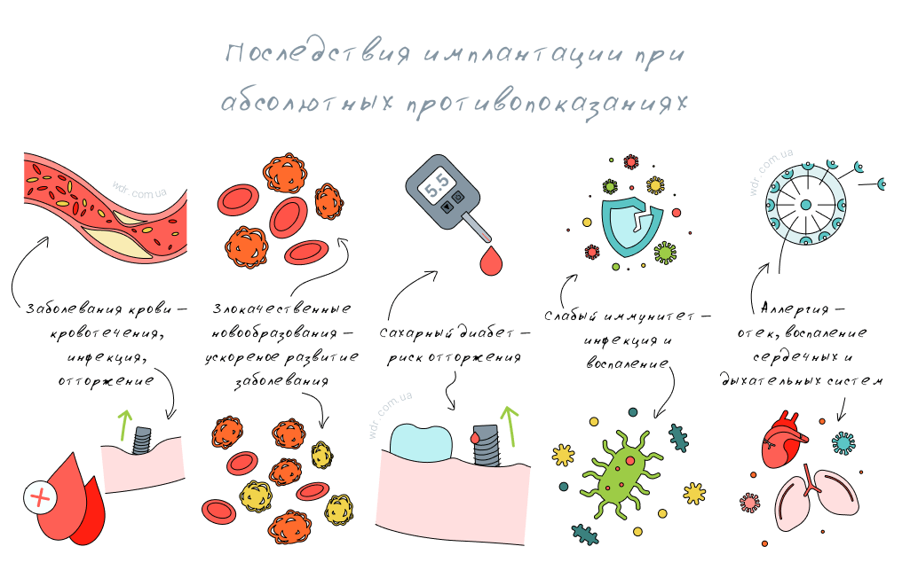 последствия имплантации стоматология WDR на Ахматовой