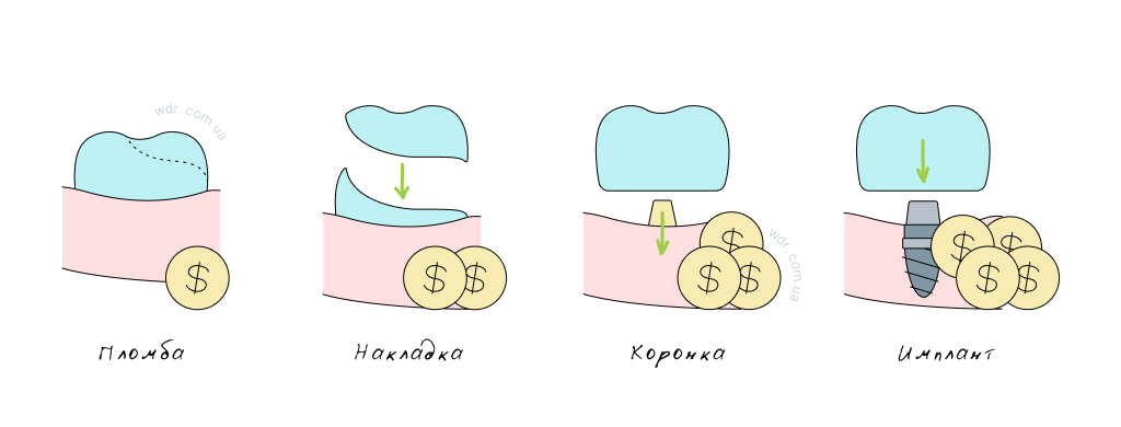 лечение зубов: пломба, накладка, коронка, имплант