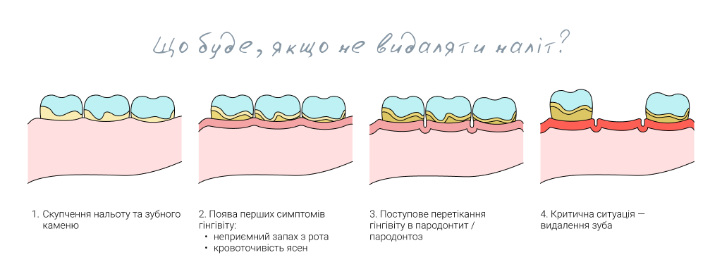 Чому важливо видаляти камінь на зубах?