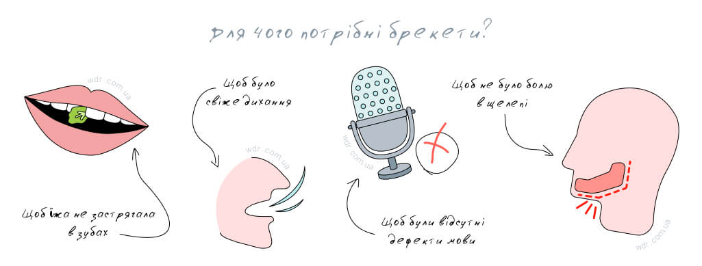 Брекети — для чого потрібні