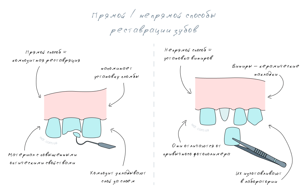 прямой и непрямой способ восстановления зубов