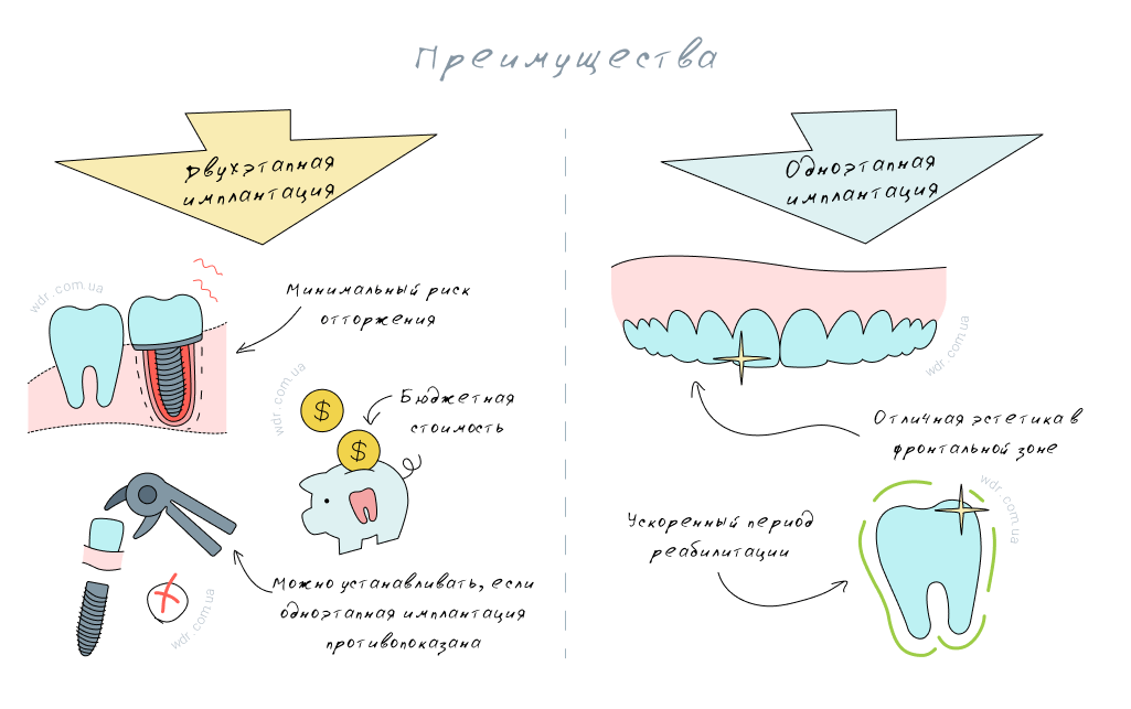 преимущества двухэтапной и одноэтапной имплантации