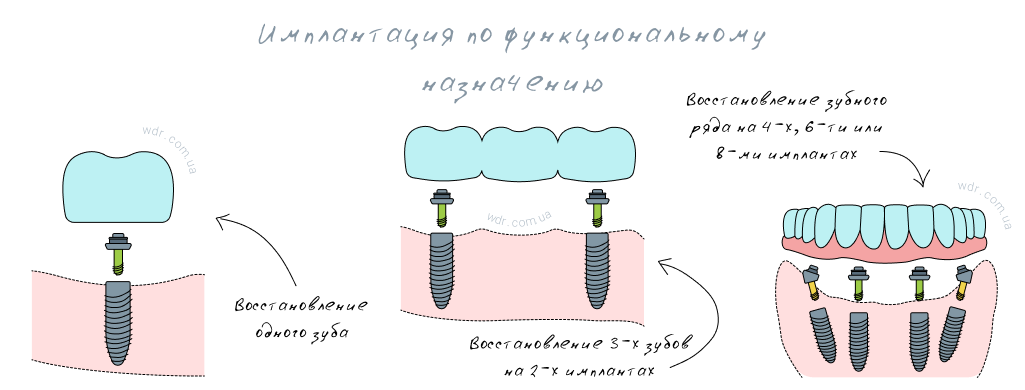 имплантация по функциональному назначению