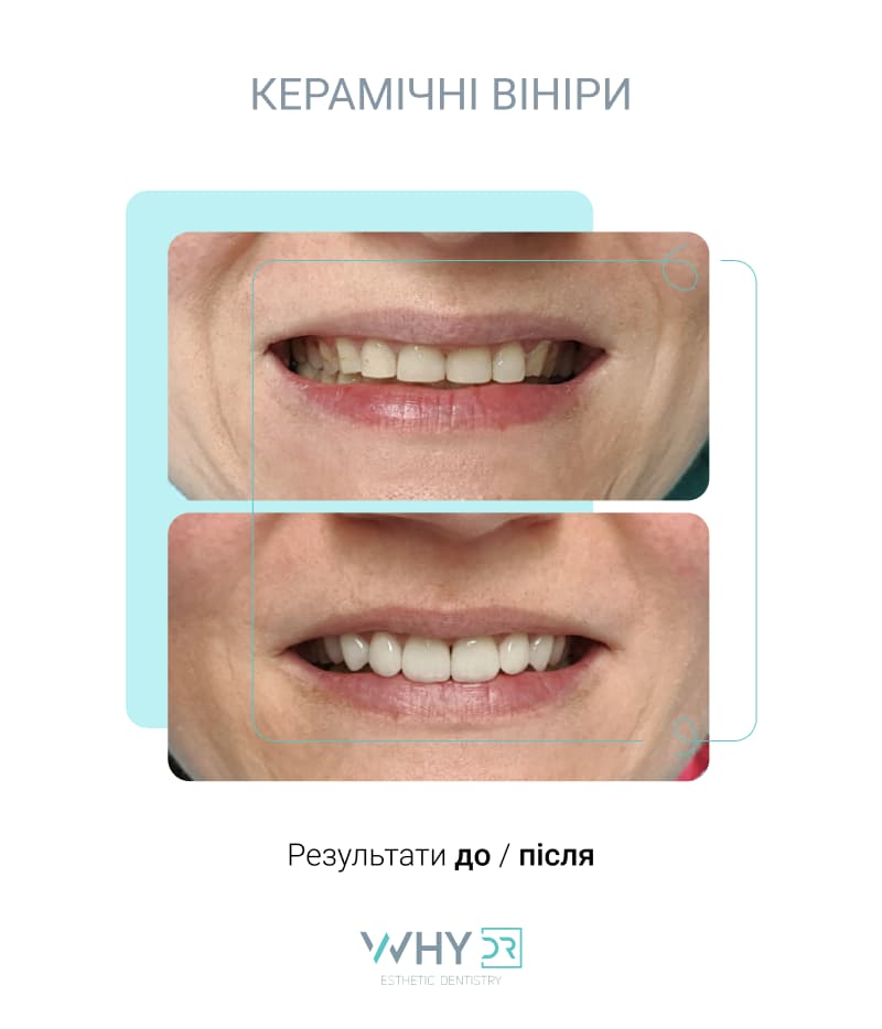 керамічні вініри
