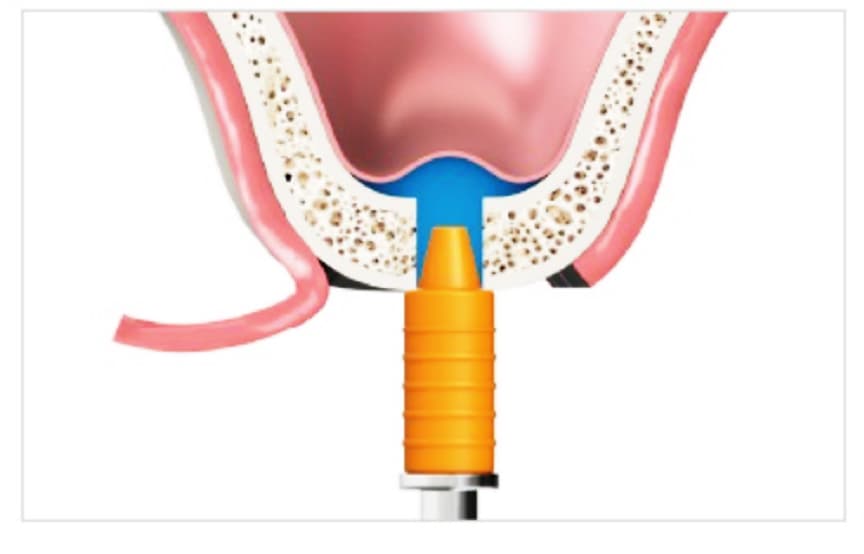 Синус лифтинг закрытый