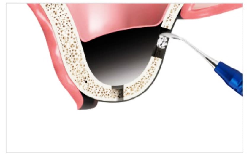 Синус лифтинг открытый