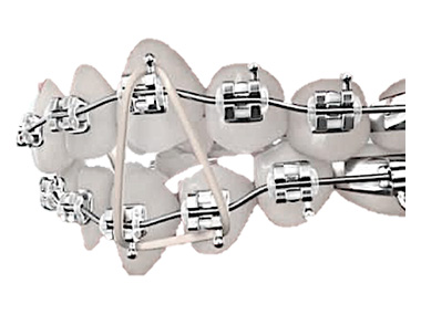 ИСПРАВЛЕНИЕ ПРИКУСА БРЕКЕТАМИ