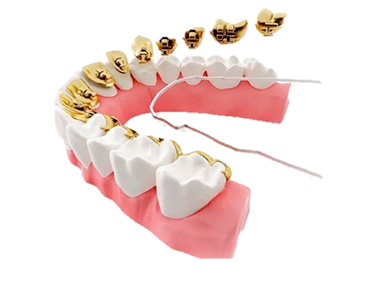 устройство брекетов